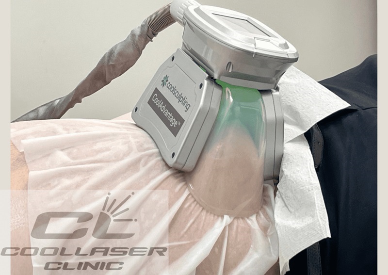 Coolsculpting