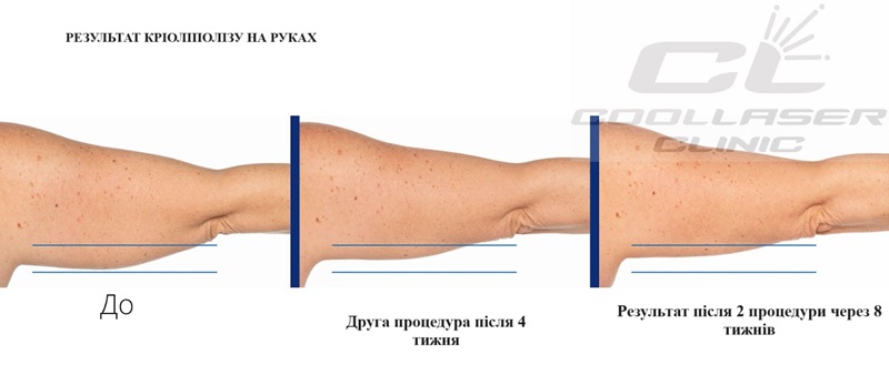 Фото кріоліполіз до і після