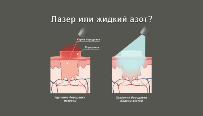Видалення бородавок азотом Київ